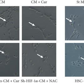 Curcumin Inhibits Hsc Induced Hcc Angiogenesis By Suppressing Hif