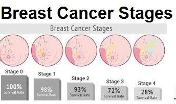 What Are The 4 Stages Of Breast Cancer, Instruction | by Farrukh ...