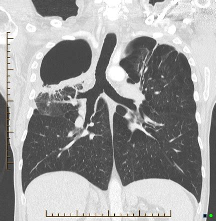 Viewing playlist: lung | Radiopaedia.org