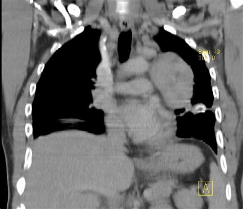 5 The Ct Reconstruction Identifies The Anterior Mediastinal Mass