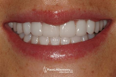 No Prep Porcelain Veneers To Widen Smile