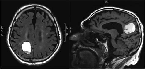 MRI brain demonstrating a mass lesion in the right parietal lobe that... | Download Scientific ...