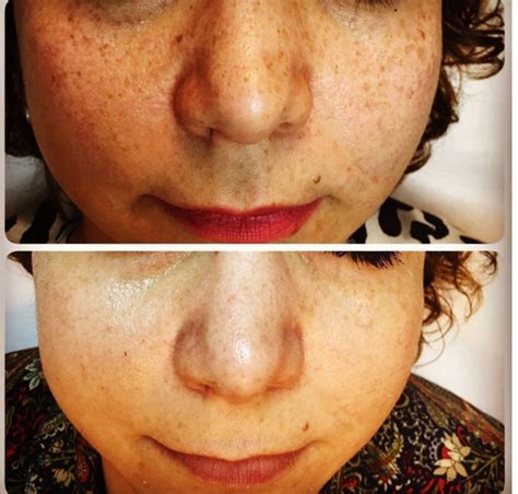 Lazerle Il Tedavisi Freckles Treatment Uzm Dr Kenan Dibek