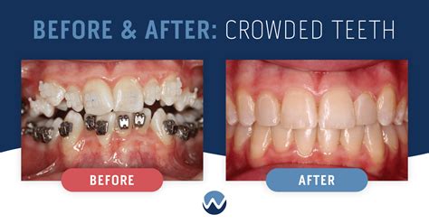 Ways We Can Help With Teeth Crowding Woodhill Dental Specialties