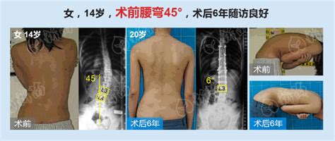 神经肌肉型侧弯矫正实例广东省新苗脊柱侧弯预防中心 脊柱侧弯新苗基金