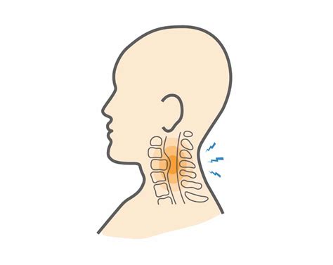 What is Cervical Myelopathy & What Are Its Common Signs? - Upswing Health