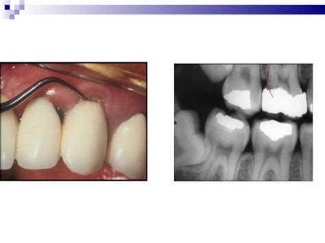 Clinical Features And Histopathology Of Dental Caries PPT