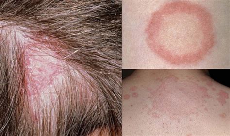 Ringworm symptoms: A ring shaped rash on your skin could indicate the ...