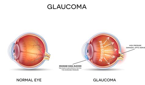 Glaucoma Exam | Wilken Family Eye Care