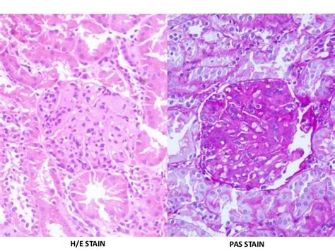 Membranoproliferative Glomerulonephritis Nephritic Nephrotic Syndrome