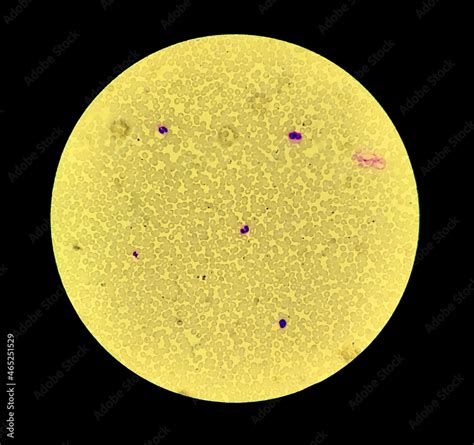 Blood Smear Leishman Stained Microscopic Show Erythroconcentration Of