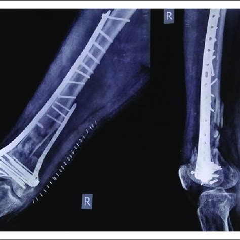 Radiograph After Iliac Crest Bone Grafting And Augmentation Of Medial Download Scientific