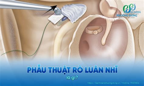 phau thuat ro luan nhi quy trinh ky thuat va cham soc hau phau