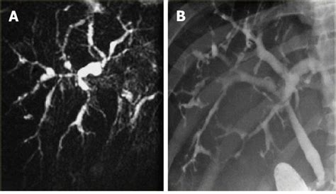 slsi.lk - how long for sulfatrim to work | Messages all acute cholangitis mri radiology ...