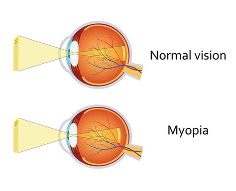 Myopia Control