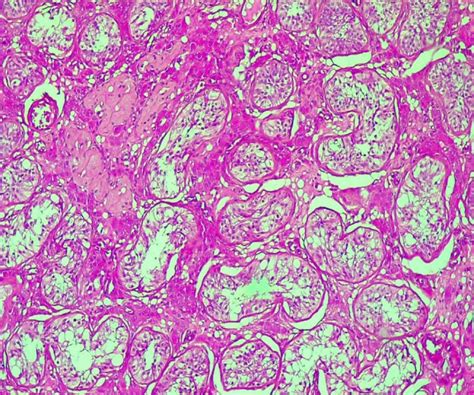 Ovotesticular Disorder Of Sex Development In A XY Adolescent A Rare