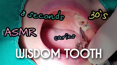 ASMR Wisdom Tooth Extraction In 8 Seconds 4k YouTube