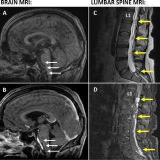 Representative Slices Of Sagittal Thoracic Spine Mri T Weighted