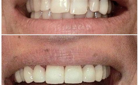 Dental Veneers By Advanced Dental Center In Louisville Ky Alignable