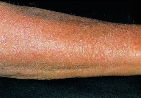 Allergic Reaction To Carbamazepine Drugs Photograph By Dr P Marazzi