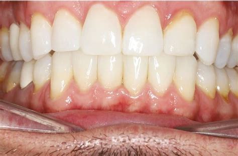 Clinical Case Unsightly Black Triangles A Tricky Restorative Procedure Made Easy With Flowable