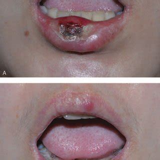 Gonorrhea On Lips Pictures | Lipstutorial.org