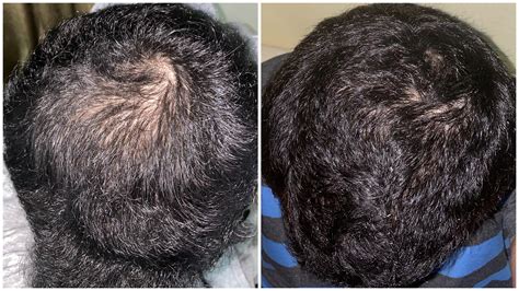 Results: Finasteride, minoxidil, 1.5mm derma roller. There are 2 to 2.5 ...