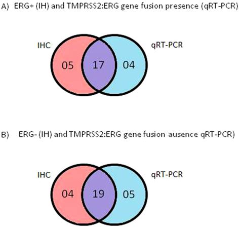 A Positive Tmprss Erg Gene Fusion Expression And Erg B Negative