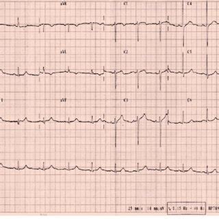 Surface 12 Lead Electrocardiogram Of The Patient During Sinus Rhythm