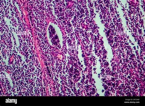 Hodgkins Lymphoma Light Micrograph Photo Under Microscope Stock