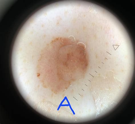 Biopsy results back - disappointing news : r/Melanoma