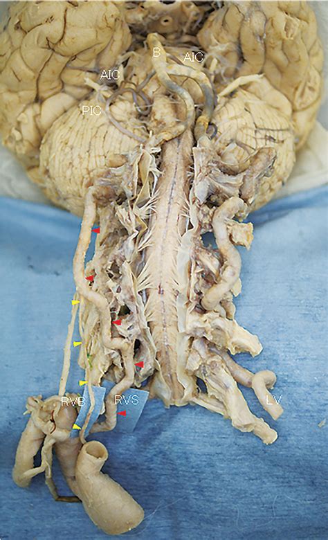 Figure From A Case Of Duplicated Right Vertebral Artery Semantic