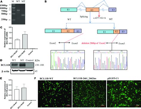 The in vitro minigene assay of the c.427 + 1G > A variant and the ... 