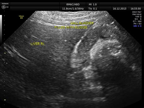 MURPHY’S LAW a.k.a. How straight forward is treating cholecystitis ...