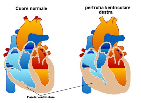 Ipertrofia Del Ventricolo Sinistro