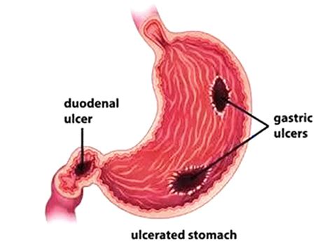 Peptic Ulcer Disease Arihant Gastroenterology