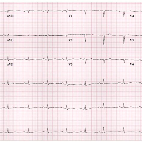 EKG on admission showing sinus rhythm with first degree AV block and... | Download Scientific ...