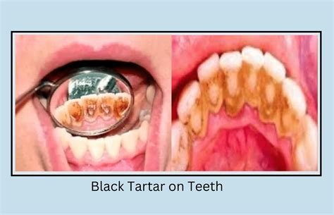 What Is Black Tartar On Teeth Complete Detail Oral Health Line