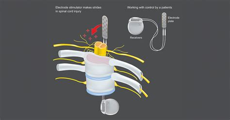 Spinal Cord Stimulation Eases Pain Boosts Function For People With Prosthetic Legs