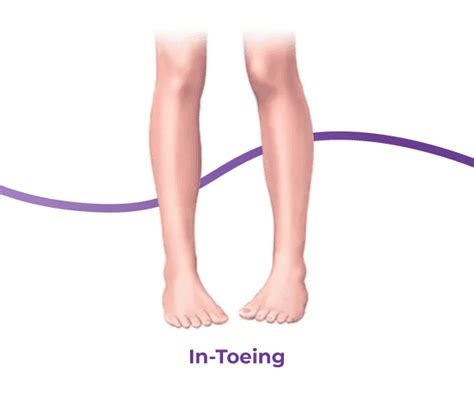 In-Toeing & Out-Toeing: Causes, Symptoms & Treatment | The Feet People ...