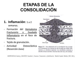 Consolidacion Osea Pptx