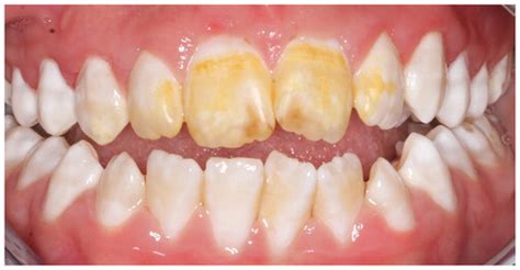 Management Of Stained Fluorotic Teeth By Combined Minimal