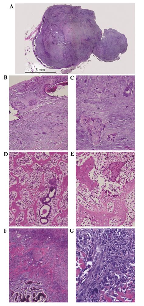 A C First Mass Removed In 2005 A Low Grade Adenosquamous Carcinoma