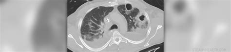 CT angiogram procedure | General center | SteadyHealth.com