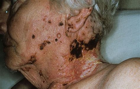 What Does Shingles Look Like Shingles Rash Pictures Blisters Under