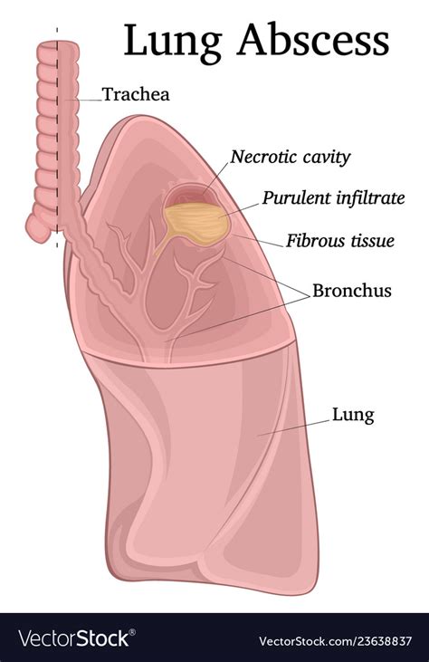 Lung abscess Royalty Free Vector Image - VectorStock