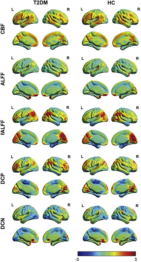 Disturbed Neurovascular Coupling In Type 2 Diabetes Mellitus Patients