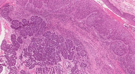 Basaloid Squamous Cell Carcinoma Of The Larynx Ottawa Atlas Of Pathology