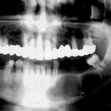 (PDF) Calcifying odontogenic cyst - Gorlin's cyst - Report of two cases