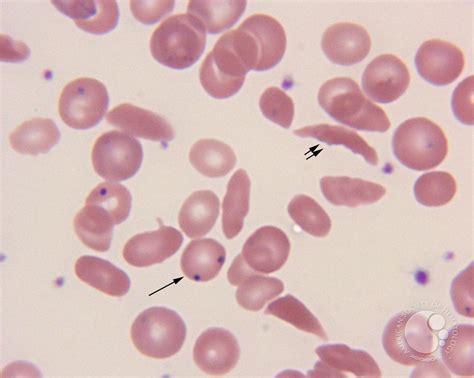 Sickle cell disease – RBC morphology - 4.